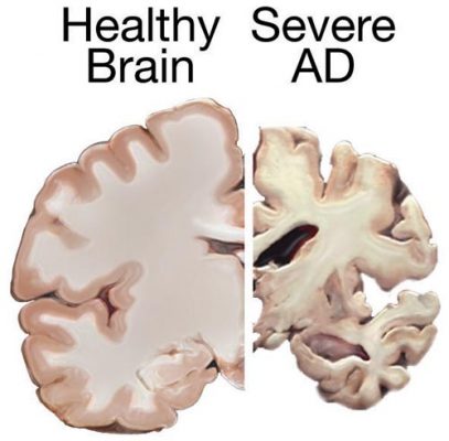 Sự khác nhau giữa não của người bình thường và người bị bệnh