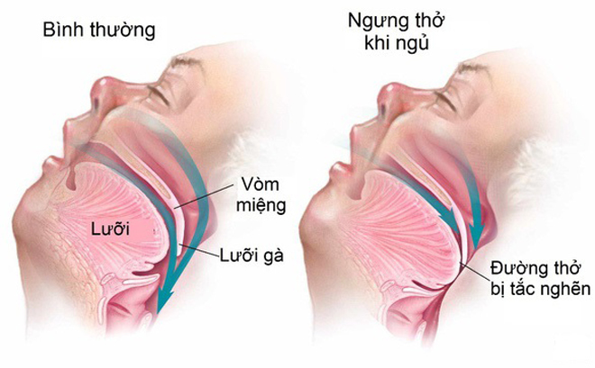 Cấu tạo họng của người bị chứng ngưng thở khi ngủ